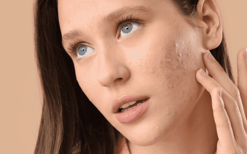 Các bước skincare da mụn đúng cách giúp giảm mụn hiệu quả