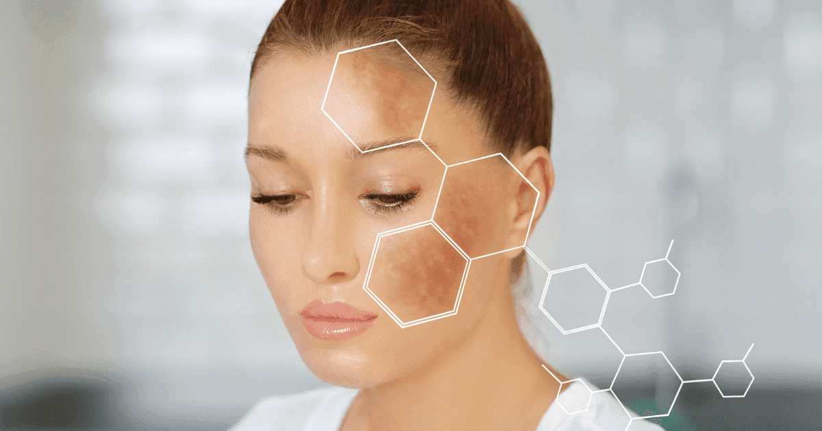 TOP +8 serum trị nám Hàn Quốc tốt nhất & được khuyên dùng