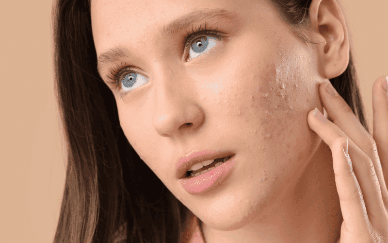 các bước skincare da mụn